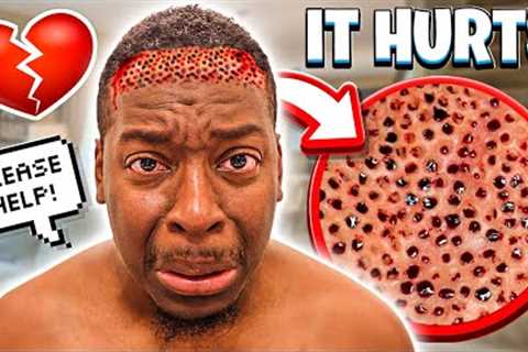 THE DOCTOR RUINED MY HAIRLINE FOREVER **BAD IDEA**